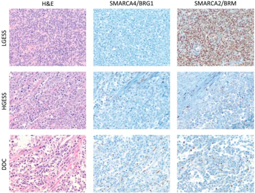 Figure 3. Immunohistochemical analysis of SMARCA4/BRG1 and SMARCA2/BRM in endometrial stromal sarcoma (ESS) and dedifferentiated