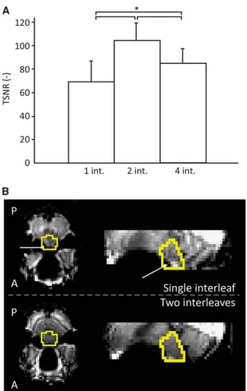 Figure 1. (A) Median temporal signal-to-noise ratio (TSNR) of the brainstem (BS) (group averages, N ¼ 5) for image acquisitions with 1, 2, and 4 spiral interleaves (int.)