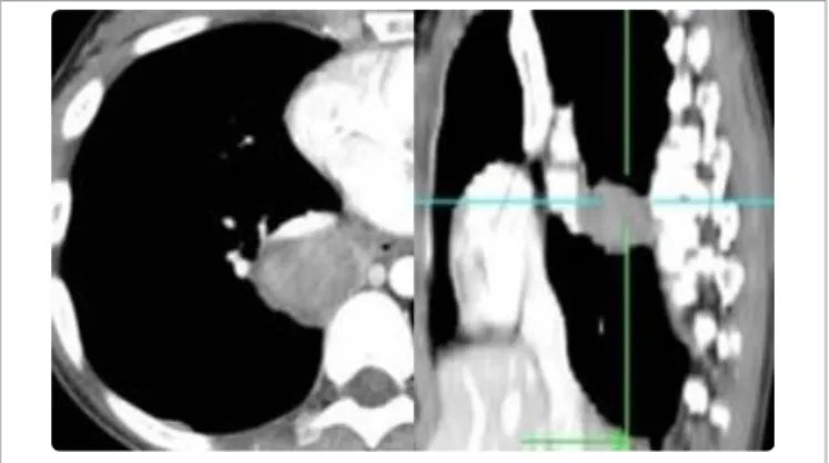 Figure 3:  Chest CT in a patient with PPL arising from the right inferior lobe.