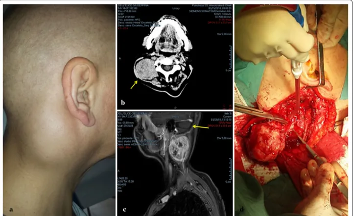 Fig. 1  Representative preoperative, CT scan, MRI, and surgical excision images. a Preoperative photograph of the mass in the right posterior neck  region