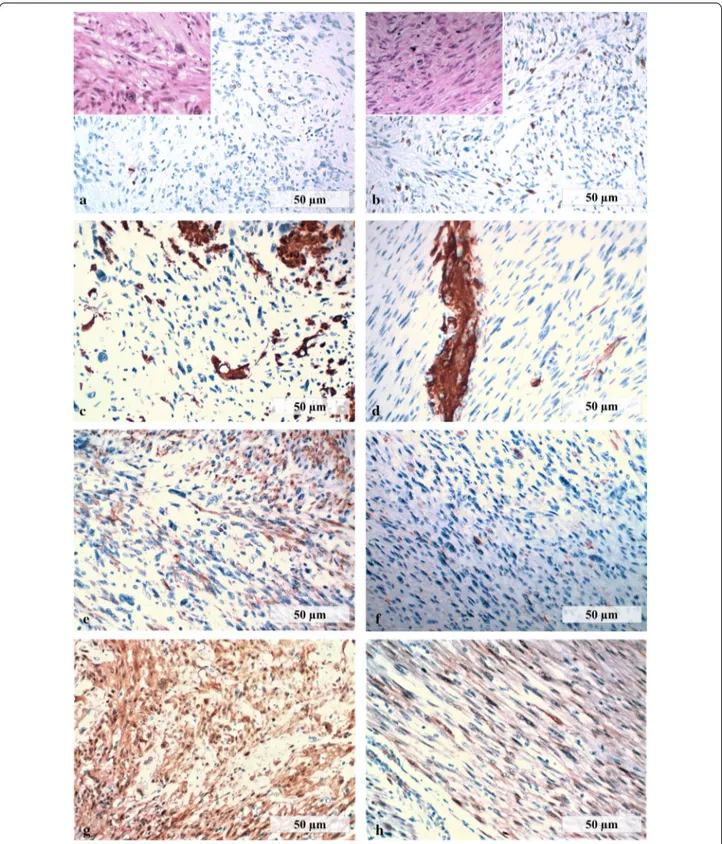 Fig. 2  Immunohistochemical evaluation of broad ligament and neck leiomyosarcomas. a MIB-1 immunoreactivity in the primary LMS