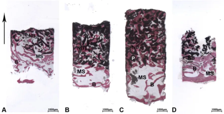 Figure 5.  Anorganic bovine bone (ABB). The biopsies were oriented in the crestal-apical direction ( ↑) and all biopsies showed a small portion of the pre-existing bone (B) with large marrow spaces  (MS)