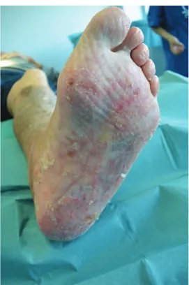 Fig. 4. Left foot at 4-month follow-up.