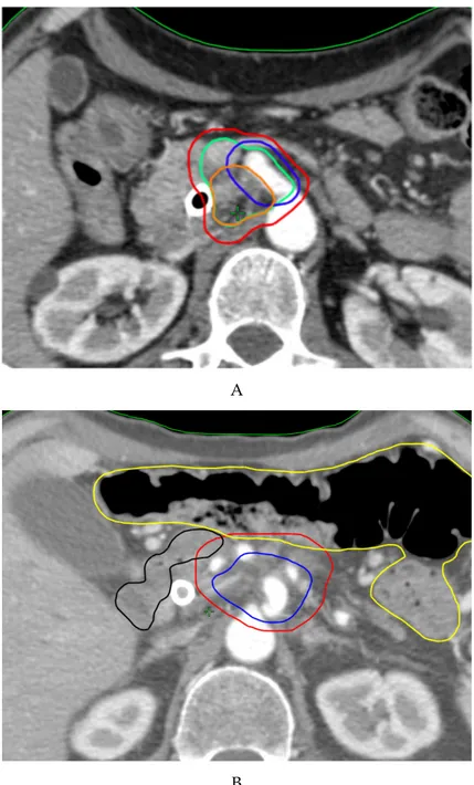 Figure 1. The Simultaneous Integrated Boost (SIB) approach for pancreatic cancer in neoadjuvant (A)  and definitive (B) setting