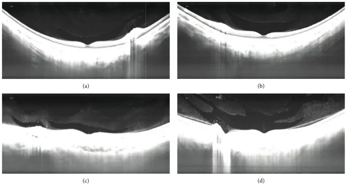 Figure 3: BPM morphology. BPM morphology was classiﬁed as a boomerang (a), as a boat (b), as a wedge (c), and as irregular (d).