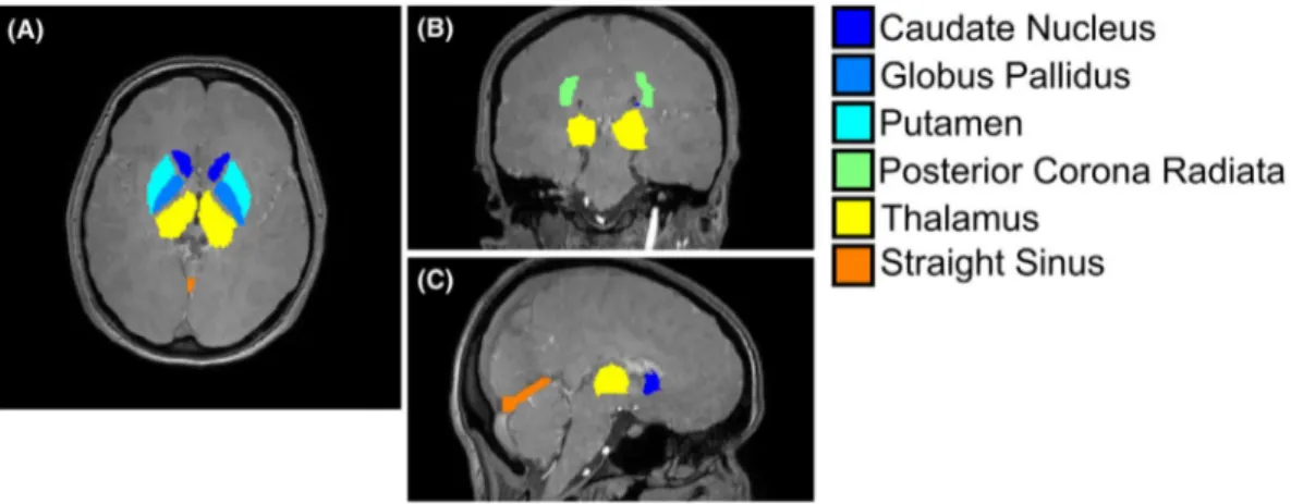 FIGURE 2  Brain regions of interest (ROIs) in a representative volunteer. For a representative healthy subject, the ROIs segmented in the  healthy volunteers are overlaid on a transverse (A), coronal (B), and sagittal (C) slice of the first-echo magnitude 