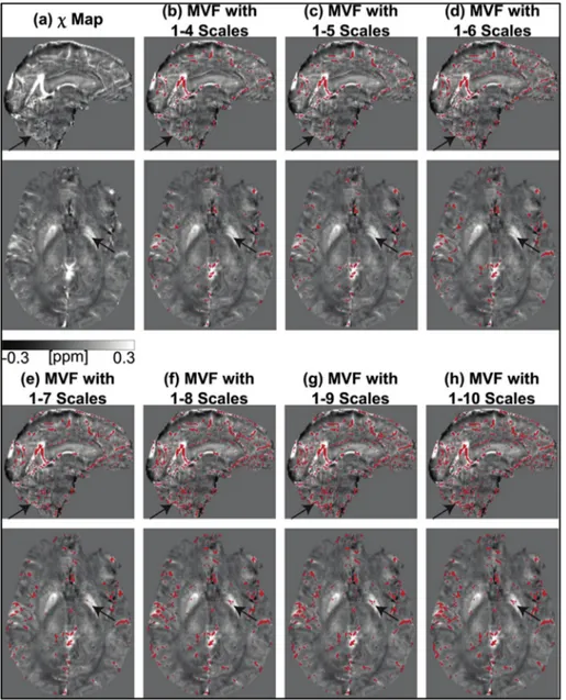 Fig. 1 shows the χ map and the corresponding MVF segmentations of a representative pre-GKR patient with a small AVM in the cerebellum (not shown in these image slices)