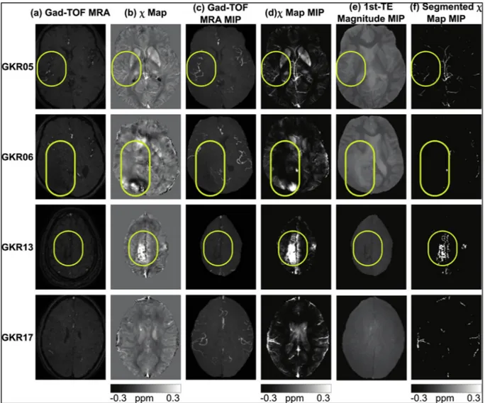 Fig. 3. Multimodal imaging appearance of brain AVMs in four representative post-GKR patients