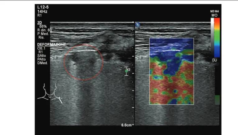Figure 2. B-mode and strain elastosonography of sub-pleural lung consolidation; the lesion displayed a blue pattern &gt;75% (hard lesion)