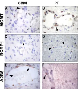 Figure 1. Immunohistochemistry analysis of glioblastoma (GBM) and peritumoral (PT) areas of  surgical samples