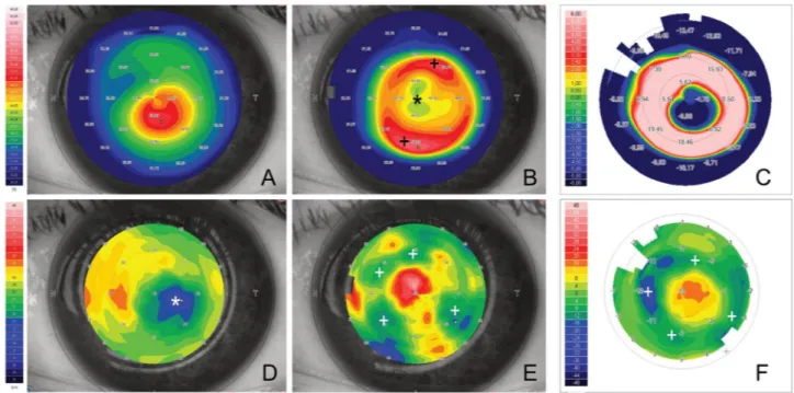 Table 1.   Corneal curvature and thickness parameters before and 1, 3 and 6 months after SLAK