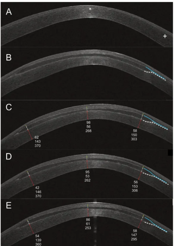 Figure 4.  Preoperative AS-OCT horizontal scan of the central cornea (A) showed normo-reflective thinned 