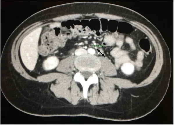 Figure 9. Lymph nodes enlargement with a maximum size of 13.63 mm (arrow) in the para-aortic site
