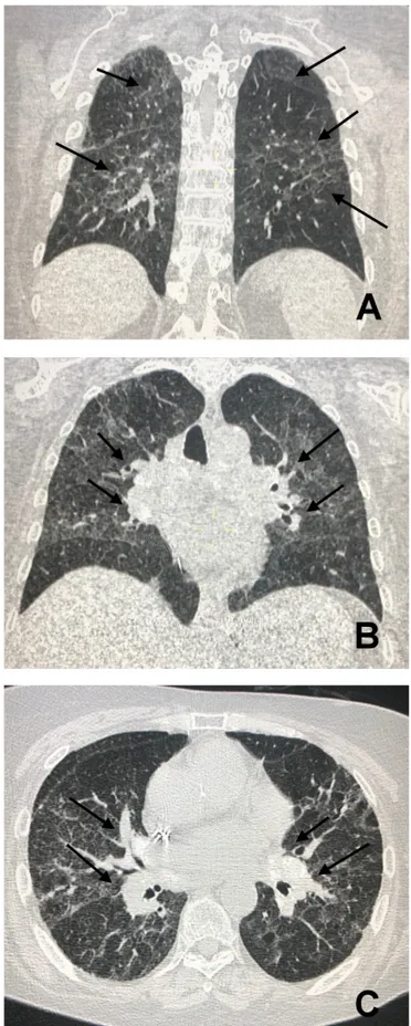 Figure 6. Panel (A) shows bilateral and asymmetrical coarse opacities of both pulmonary fields  (arrows)