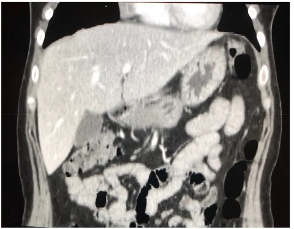 Figure 7. Massive hepatomegaly in a patient with sarcoidosis. 