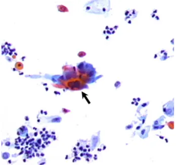 Figure 2 Bladder cytological sample, showing the presence of malignant squamous  cells  (black  arrow)  as  extrinsic  infiltration  from  cervical  carcinoma  (original  magnification ×200).