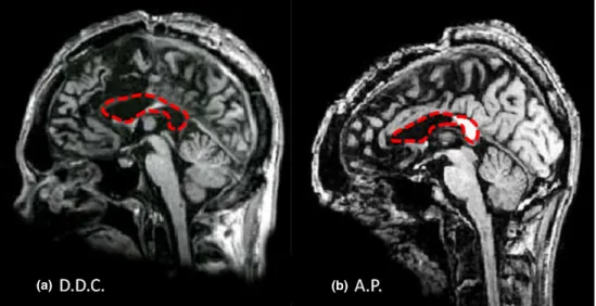 Figure 1. Midsagittal MRI of patients: D.D.C.’s brain, showing the complete absence of callosal fibres (panel on the left), and A.P.’s brain, showing the callosal section which saves the splenium (panel on the right).