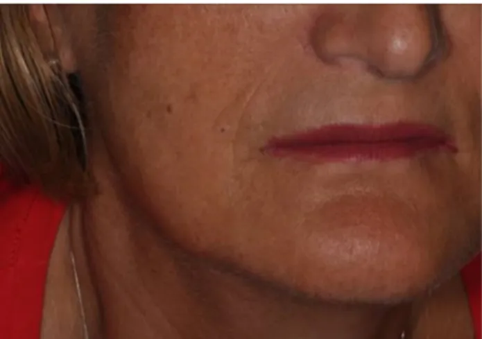 Fig. 3 Appearance of a typical patient 30 days after undergoing dermabrasion with voltaic arc technique