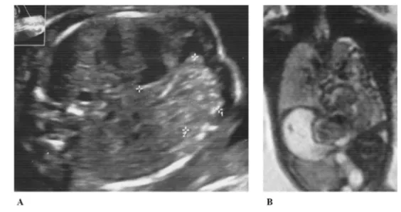 Fig.  1  – Chest  images from prenatal  ultrasound  (A)  and magnetic  resonance imaging (B) 