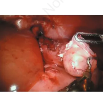 Figure 1. Accurate enucleation of the gastric duplication cysts. Figure  2.  Closure  of  the  muscle  layer  of  the  gastric  wall  with interrupted sutures.