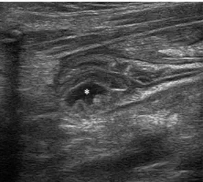 Fig. 3. Small nodule of HGM recapitulating the normal gastric, oxyntic mucosal architecture, lying deep in the submucosa; two gland-like structures are present (arrows) (EE, 2.5×); in the box: gland-like architecture in the submucosal HGM nodule and normal
