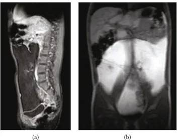 Figure 1: (a, b) MRI ((a) T1 weighted, (b) Thrive sequences) showing the mass occupying the entire abdominal cavity, compressing and displacing the bowel, the inferior vena cava, and common iliac veins.