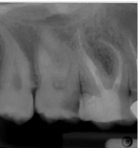 Figure 3 CB-CT image showing the S-shaped anatomy of DB root.