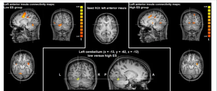 FIGURE 3 | Group statistical maps of intrinsic functional connectivity analysis based on the left anterior insula seed ROI showing significantly higher connectivity (t &gt; 3.20, p &lt; 0.05 corrected) in left cerebellum in the low ES group, compared to th