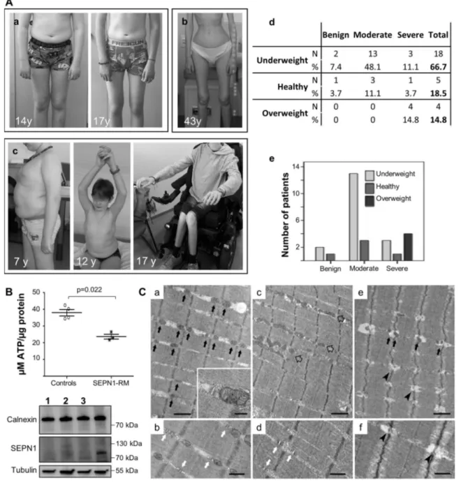 Fig. 7 Abnormalities in body composition, ATP levels, and SR- SR-mitochondrial contacts in patients con ﬁrm defective bioenergetics as a novel pathomechanism in SEPN1-RM
