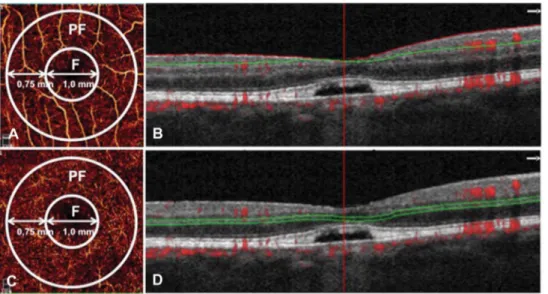 Fig. 1. Optical coherence tomography angiography (OCTA) from an enrolled adult-onset foveomacular vitelliform  de-generation patient
