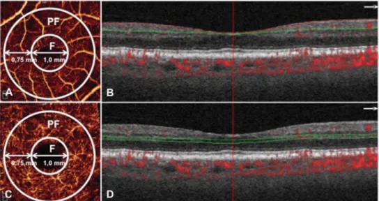 Fig. 2. Optical coherence tomography angiography (OCTA) from an enrolled age-related macular degeneration patient