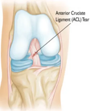 Figure 2. A complete tear of ACL  The anterior cruciate ligament can be injured in several ways: 