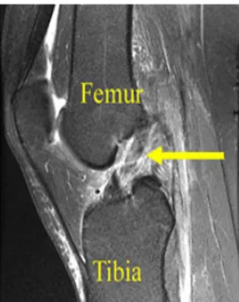 Figure 3. MRI of complete ACL tear  