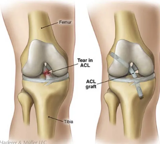 Figure 5. ACL reconstruction 
