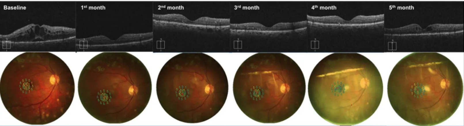 Fig 1. Follow-up of a patient affected by diabetic macular edema undergoing Ozurdex implant