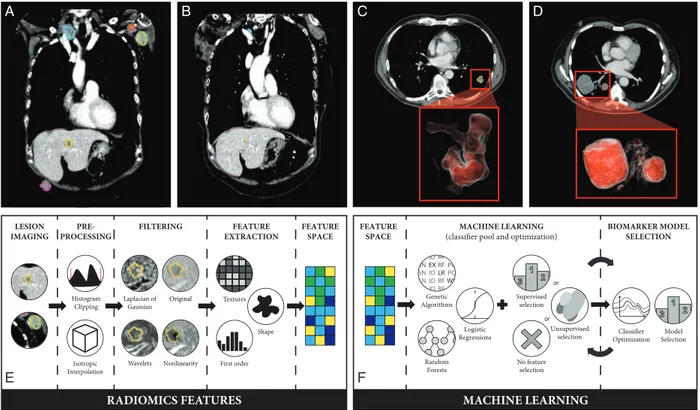 Figure 1. (A) Baseline contrast-enhanced CT scan of melanoma patient presenting with metastases in the liver and lymph nodes in the axilla and subclavicular area