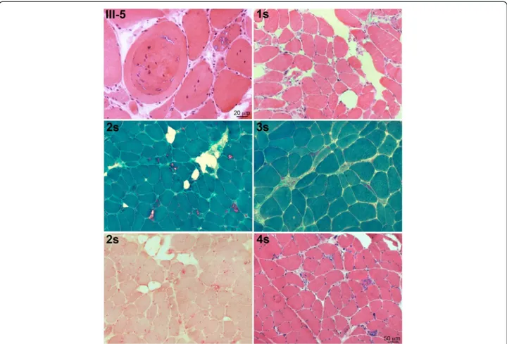 Fig. 2 Histopathological characterization of muscle biopsies in patients III:5, and 1 to 4s, showing, by H&amp;E and Gomori trichrome stains, rimmed vacuoles, internalized myonuclei, and variability of fiber diameters in all patient muscles; by acid phosph