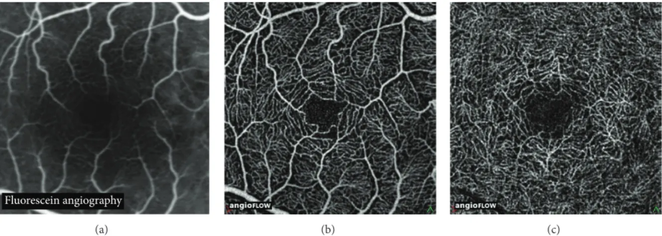 Figure 1: Fluorescein angiography image of the central macula in a healthy subject (a)