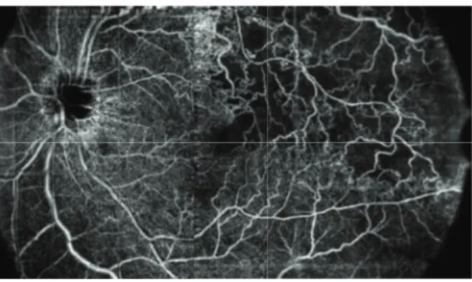 Figure 2: OCT angiography (composition map of three partially overlapping 8 × 8 mm scans) of a 57-year-old woman with branch retinal vein occlusion (BRVO) showing enlargement of foveal avascular zone and retinal nonperfused area (capillary drop-out) at the