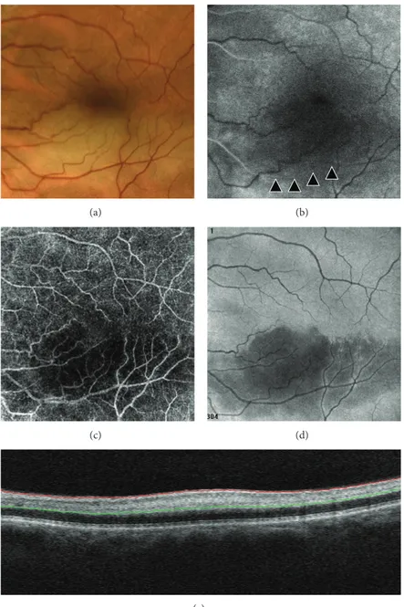 Figure 4: Branch retinal artery occlusion (BRAO) of a 62-year-old man showing a band of retinal whitening extending inferior-temporally from the disc in a color image (a)