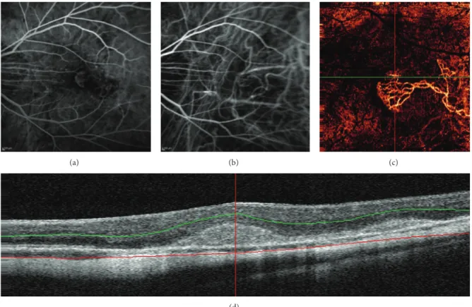 Figure 5: Simultaneous fluorescein angiography (a) and Indocyanine green angiography arteriovenous phase (b) showing myopic choroidal neovascularization