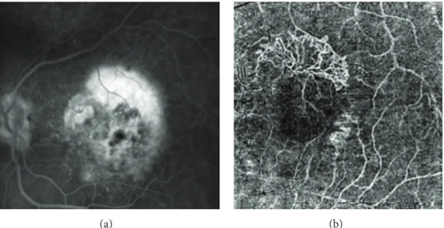 Figure 7: Fluorescein angiography (a) shows late leakage from classical choroidal neovascularization