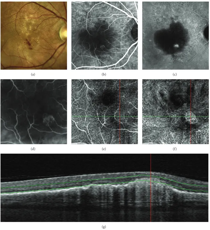 Figure 8: Multimodal retinal imaging of retinal angiomatous proliferation (RAP): color picture (a) showing intraretinal hemorrhages and exudates
