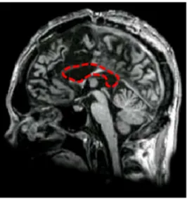 Figure 1. Midsagittal MRI of patients: the figure shows D.D.C.’s brain, showing the complete absence  of callosal fibers (in the area delimited by the red-dashed line)