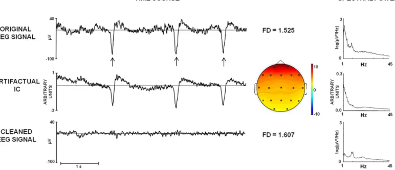 Fig 1. Example of EEG pre-processing by ICA. Time course (5 seconds, filtered between 1 and 70 Hz) and corresponding Power Spectral Density (PSD) of: First row: original EEG signals (Fp2), where the ocular artifacts are evident (vertical arrows), correspon