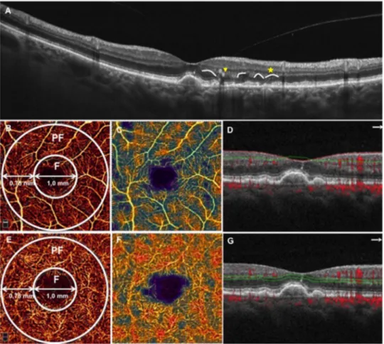 Figure 1 Spectral domain optical coherence tomography (SD-OCT) and optical coherence tomography angiography (OCTA) from an enrolled patient with intermediate age-related macular degeneration