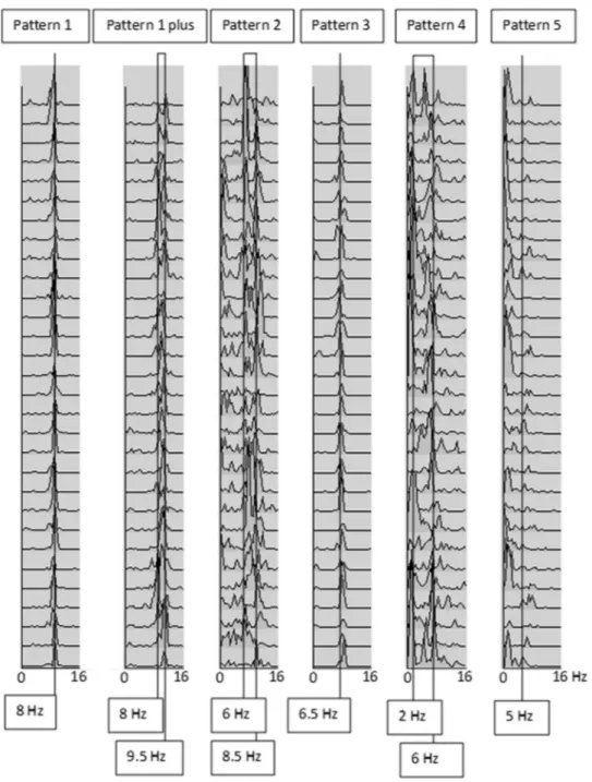 Fig. 2. CSA of EEG recording from occipital derivations in 2 MCI patients (ﬁrst 2 traces) and 4 DLB patients, showing the 6 EEG patterns described in the present study and in the previous EEG study ( Bonanni et al., 2008 )