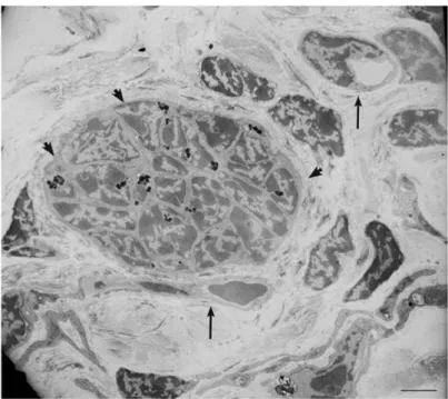 Figure 6. Ultrastructural view of paraganglioma xenograft tissue. The electron micrograph,