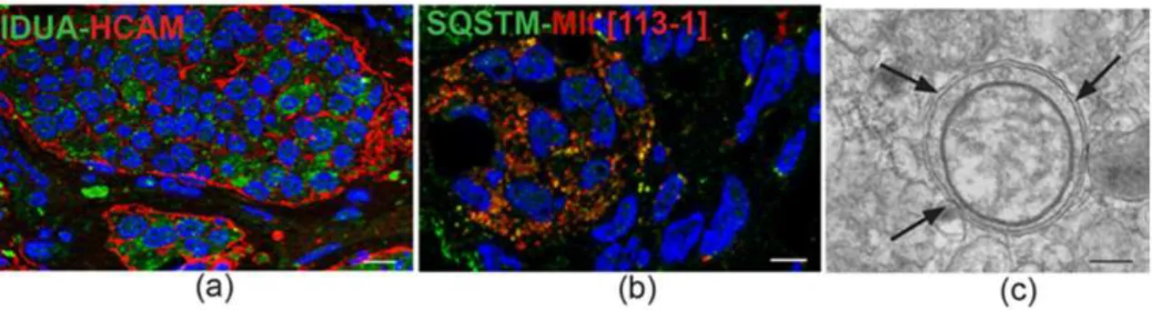 Figure 2. IDUA protein immunostaining and mitophagy in head and neck paraganglioma. (a) Immunofluorescence detects cytoplasmic IDUA protein labeling (green) in the neuroepithelial zellballen of paraganglioma