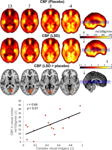 Fig. 1. Whole-brain cerebral blood flow maps for the placebo and LSD conditions, plus the difference map (cluster-corrected, P &lt; 0.05; n = 15).